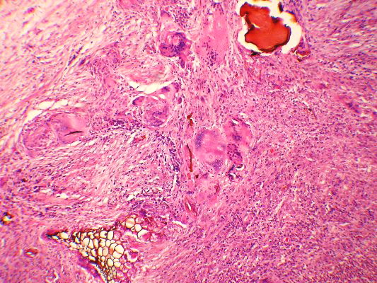 regime alimentaire diverticules