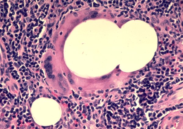 pediatric malignant histiocytosis