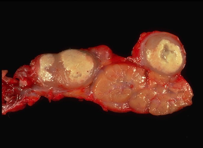 Acquired Childhoood Aphasia Acquired Childhoood Aphasia