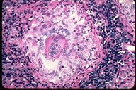 Non-necrotizing granuloma