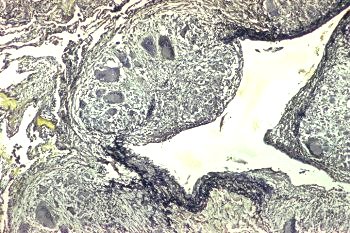 Granulomatous angiitis