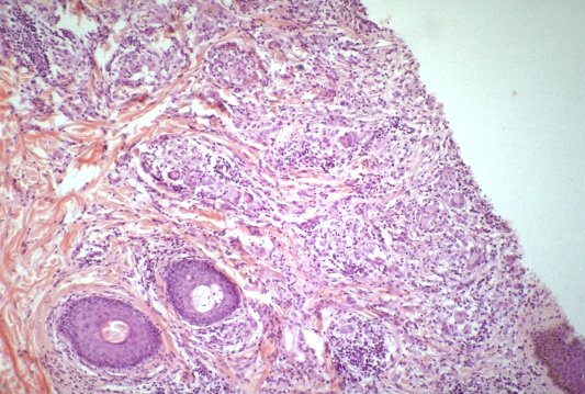 lepromatous leprosy images lepromatous leprosy images